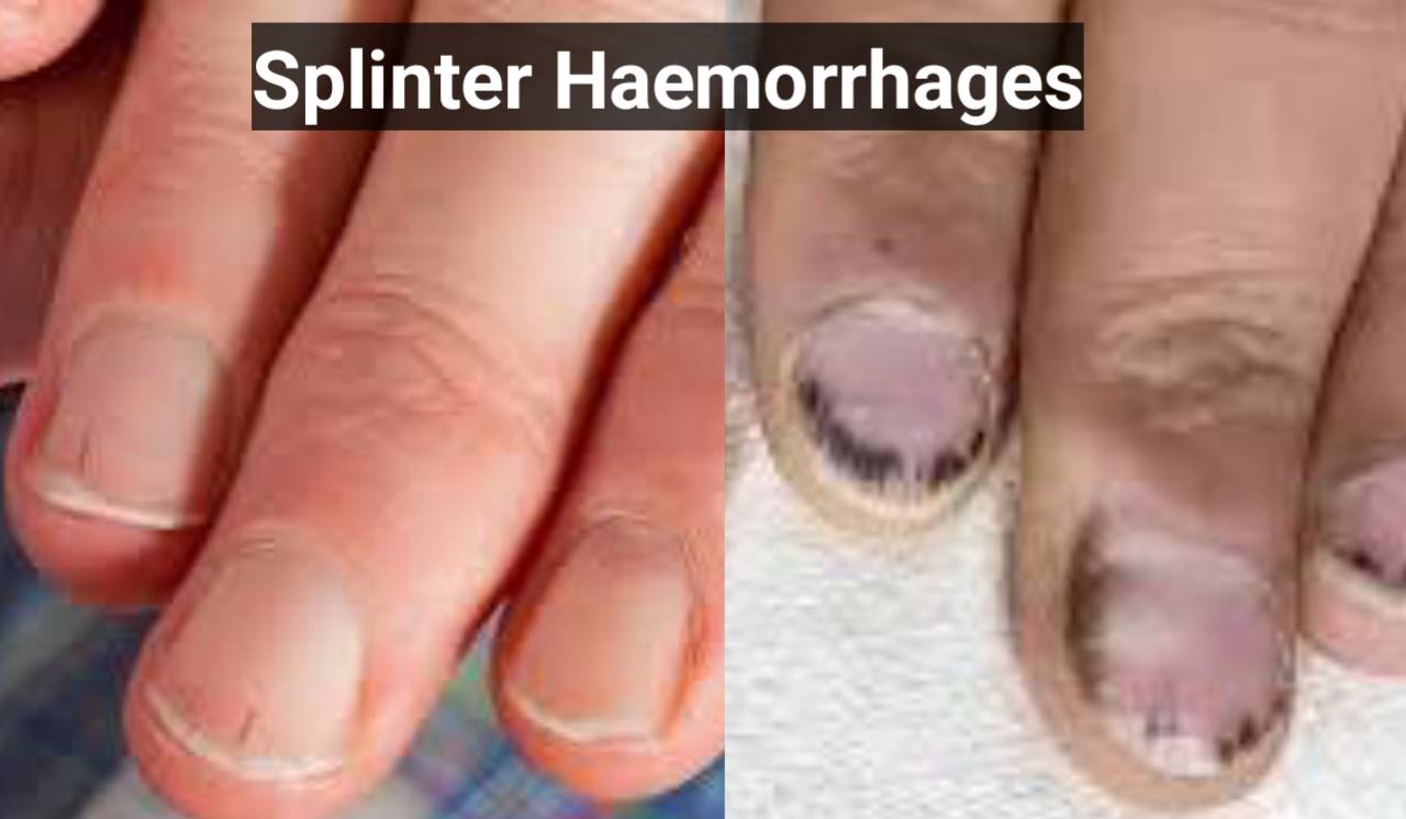 Splinter Haemorrhages
