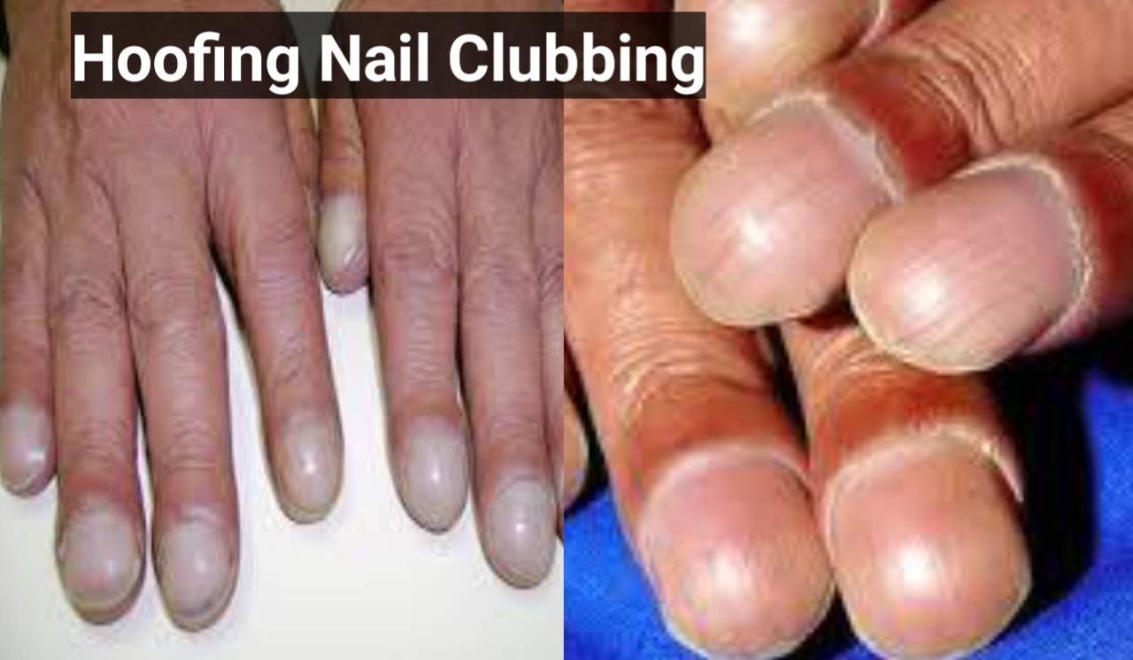 nail clubbing